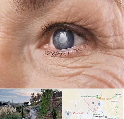 متخصص آب مروارید در باغستان کرج