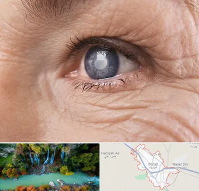 متخصص آب مروارید در دورود