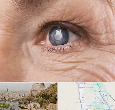 متخصص آب مروارید در فرهنگ شهر شیراز