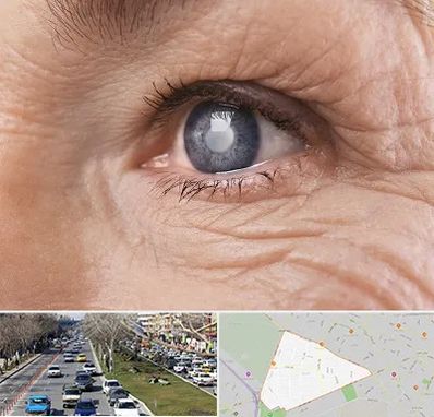 متخصص آب مروارید در احمدآباد مشهد