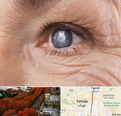 متخصص آب مروارید در ولیعصر