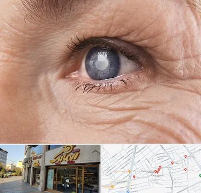 متخصص آب مروارید در عطاران قم