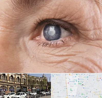 متخصص آب مروارید در منطقه 11 تهران