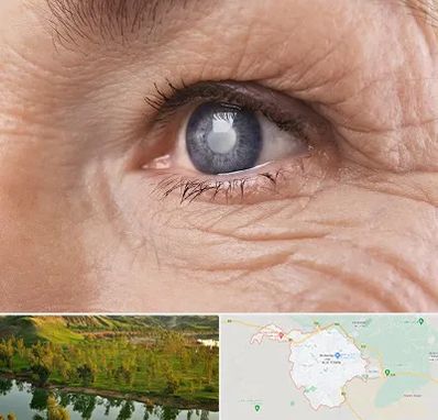 متخصص آب مروارید در بهبهان