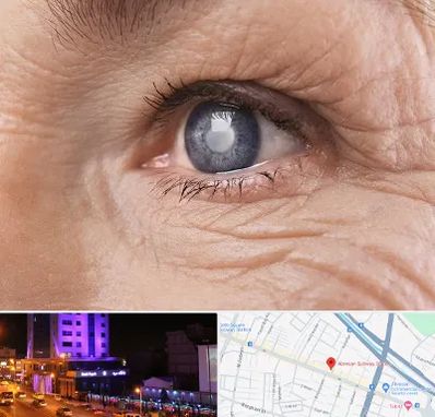 متخصص آب مروارید در آبرسان تبریز