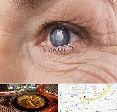 متخصص آب مروارید در میدان ولیعصر