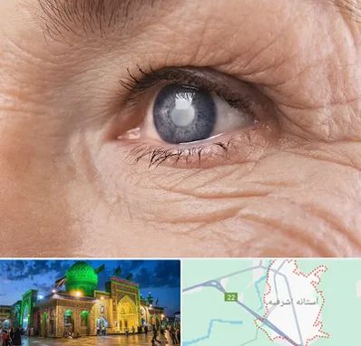 متخصص آب مروارید در آستانه اشرفیه