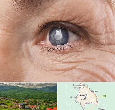 متخصص آب مروارید در آمل