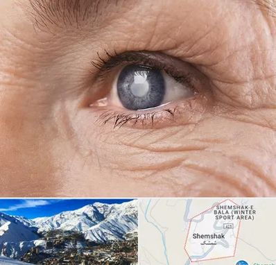 متخصص آب مروارید در شمشک