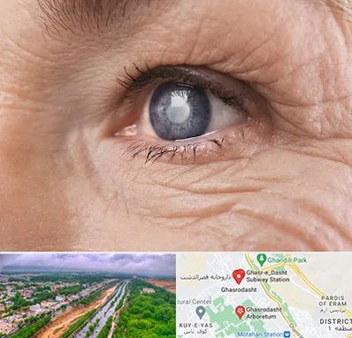 متخصص آب مروارید در قصرالدشت شیراز