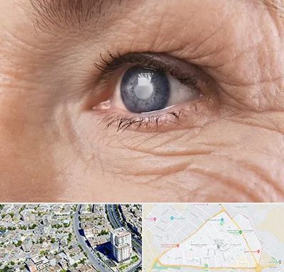 متخصص آب مروارید در قاسم آباد مشهد