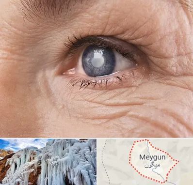 متخصص آب مروارید در میگون