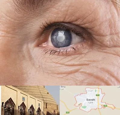 متخصص آب مروارید در ساوه