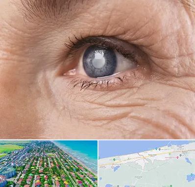 متخصص آب مروارید در فریدونکنار