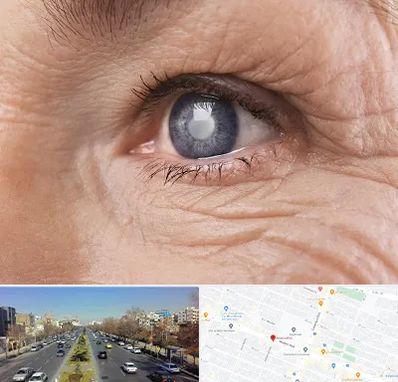 متخصص آب مروارید در بلوار معلم مشهد