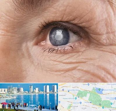 متخصص آب مروارید در چیتگر