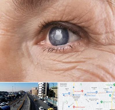 متخصص آب مروارید در پیروزی