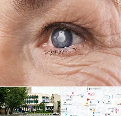 متخصص آب مروارید در طالقانی