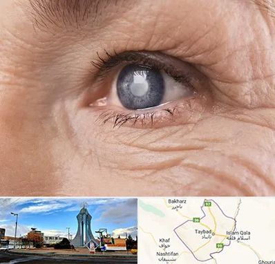 متخصص آب مروارید در تایباد