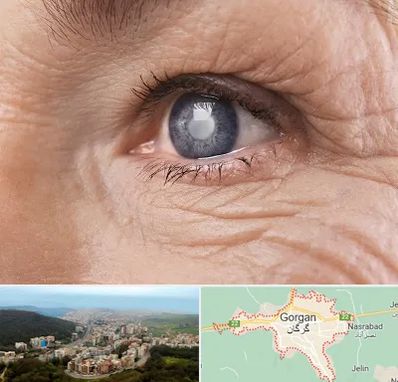 متخصص آب مروارید در گرگان