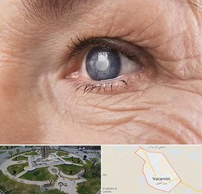 متخصص آب مروارید در ورامین