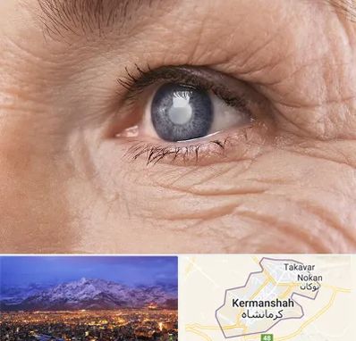 متخصص آب مروارید در کرمانشاه