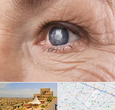 متخصص آب مروارید در هاشمیه مشهد