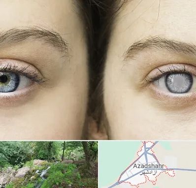 متخصص آب سیاه (گلوکوم) در آزادشهر