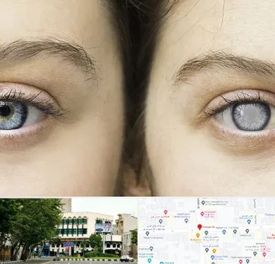 متخصص آب سیاه (گلوکوم) در طالقانی 