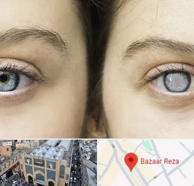 متخصص آب سیاه (گلوکوم) در بازار رضا مشهد