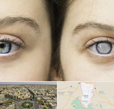 متخصص آب سیاه (گلوکوم) در قزوین