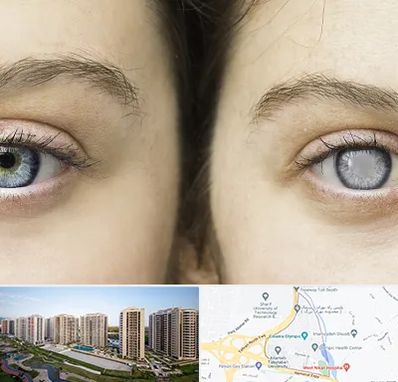 متخصص آب سیاه (گلوکوم) در المپیک 