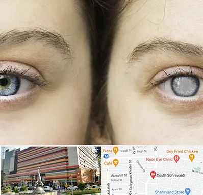 متخصص آب سیاه (گلوکوم) در سهروردی 