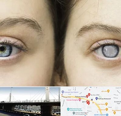 متخصص آب سیاه (گلوکوم) در پارک وی 