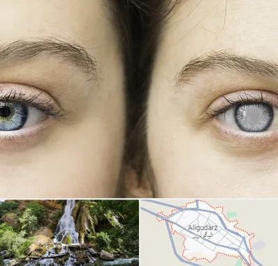 متخصص آب سیاه (گلوکوم) در الیگودرز