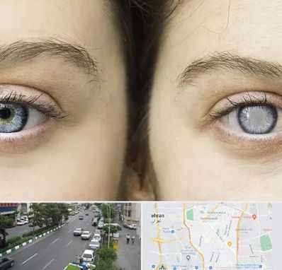 متخصص آب سیاه (گلوکوم) در ستارخان 