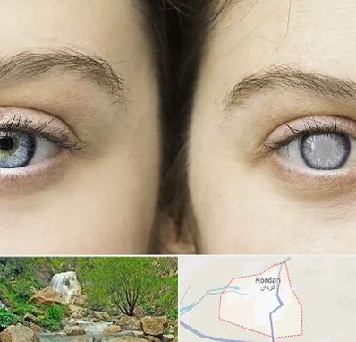 متخصص آب سیاه (گلوکوم) در کردان