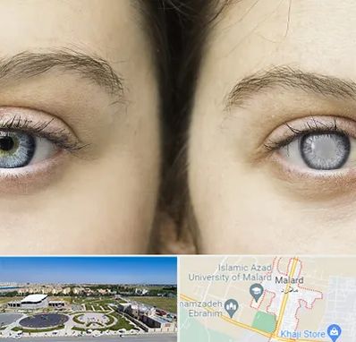 متخصص آب سیاه (گلوکوم) در ملارد