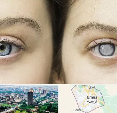 متخصص آب سیاه (گلوکوم) در ارومیه