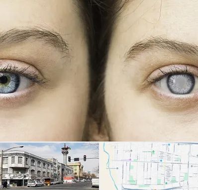 متخصص آب سیاه (گلوکوم) در 17شهریور