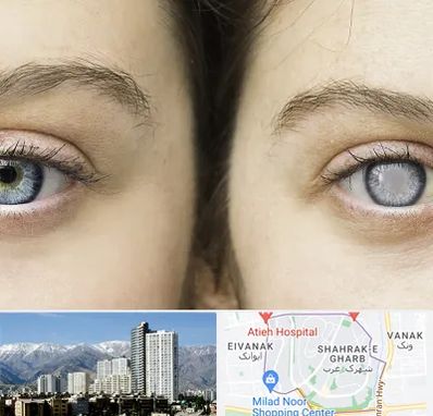 متخصص آب سیاه (گلوکوم) در شهرک غرب 