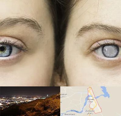 متخصص آب سیاه (گلوکوم) در میناب