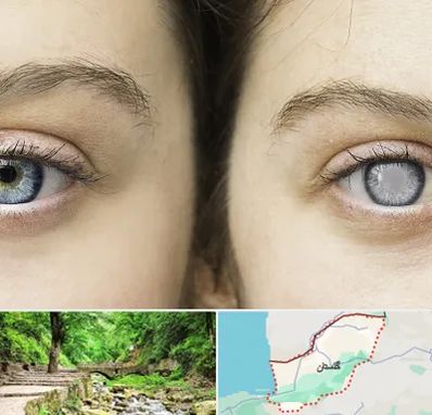 متخصص آب سیاه (گلوکوم) در گلستان