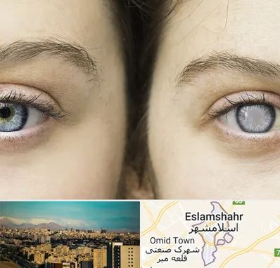 متخصص آب سیاه (گلوکوم) در اسلامشهر