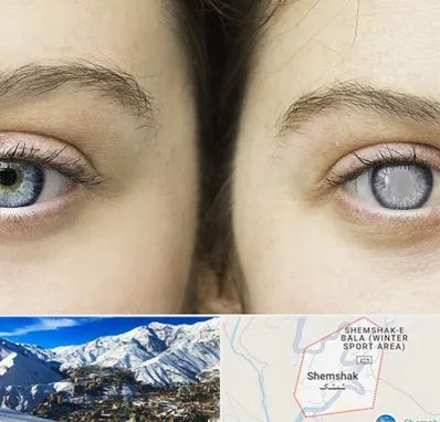 متخصص آب سیاه (گلوکوم) در شمشک