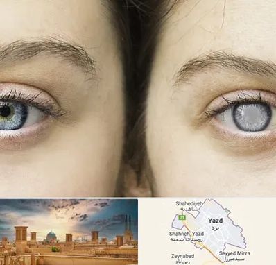 متخصص آب سیاه (گلوکوم) در یزد