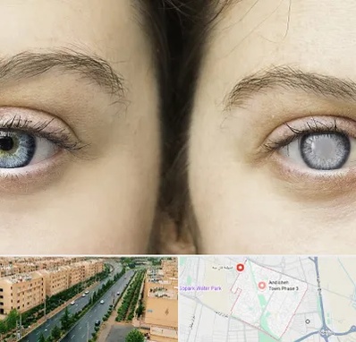 متخصص آب سیاه (گلوکوم) در فاز سه اندیشه