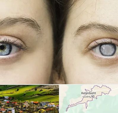 متخصص آب سیاه (گلوکوم) در کلاردشت