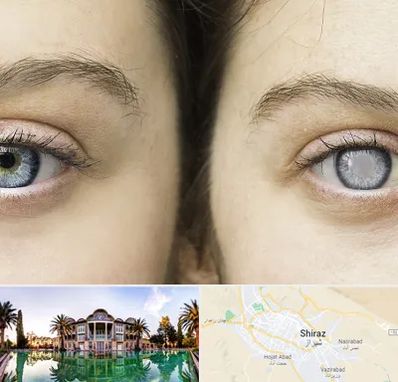 متخصص آب سیاه (گلوکوم) در شیراز