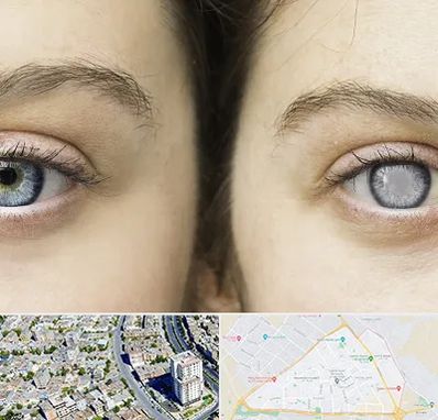 متخصص آب سیاه (گلوکوم) در قاسم آباد مشهد 